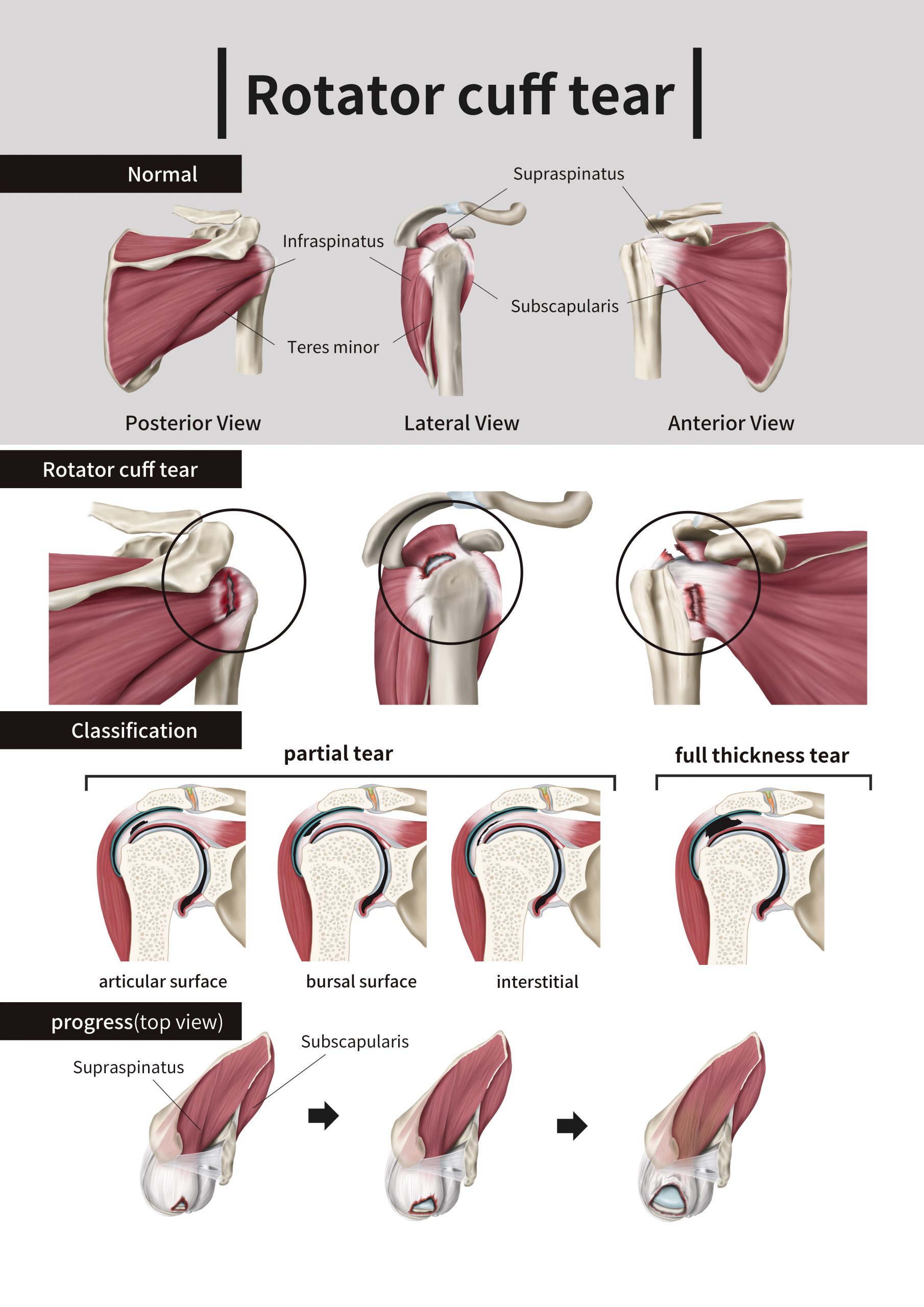 rotator cuff training